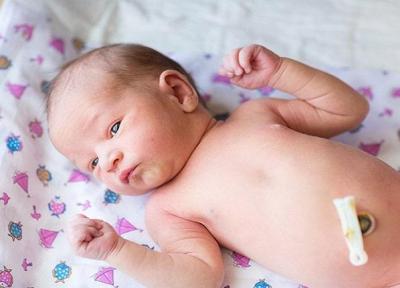 در افتادن بند ناف نوزاد، چه مواردی را مدنظر قرار دهیم؟ در افتادن بند ناف نوزاد، چه مواردی را مدنظر قرار دهیم؟