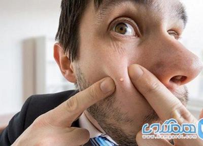 چرا جوش می زنیم و چگونه درمانش کنیم؟ چرا جوش می زنیم و چگونه درمانش کنیم؟