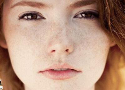 درمان های خانگی برای رفع کک و مک درمان های خانگی برای رفع کک و مک